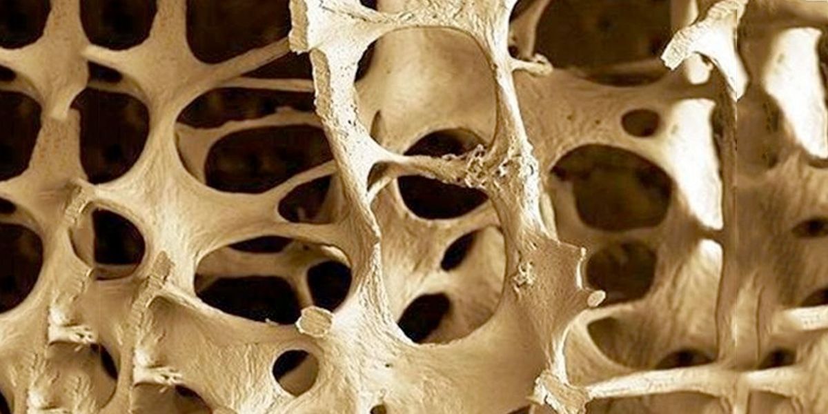 Nuevas guías de tratamiento y diagnostico de la osteoporosis