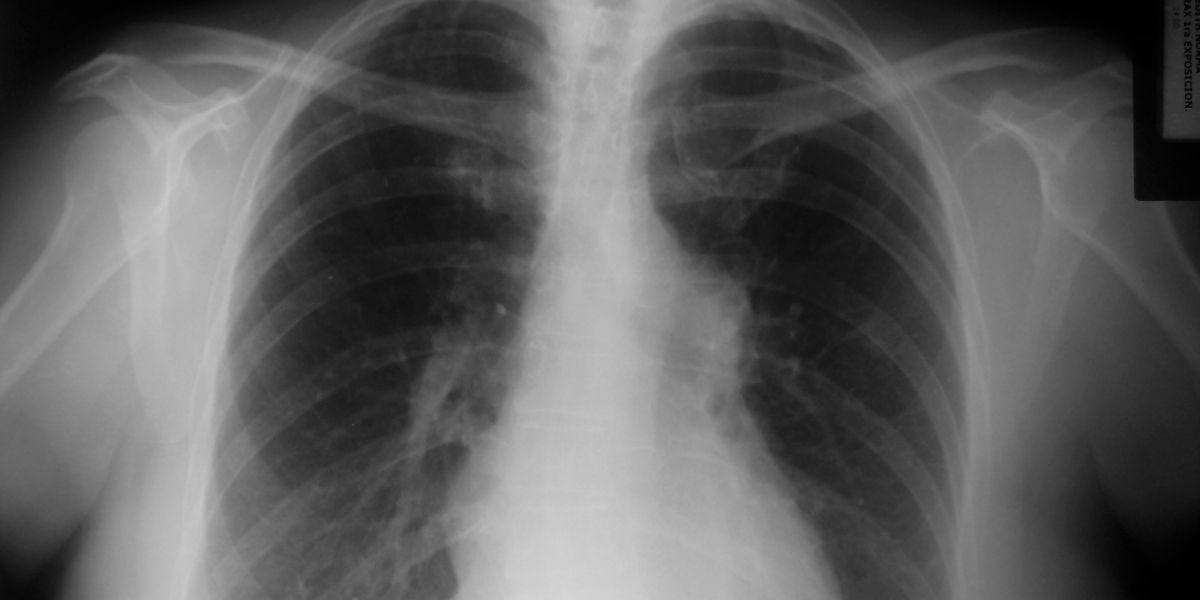 Tratamientos complementarios para el enfisema pulmonar