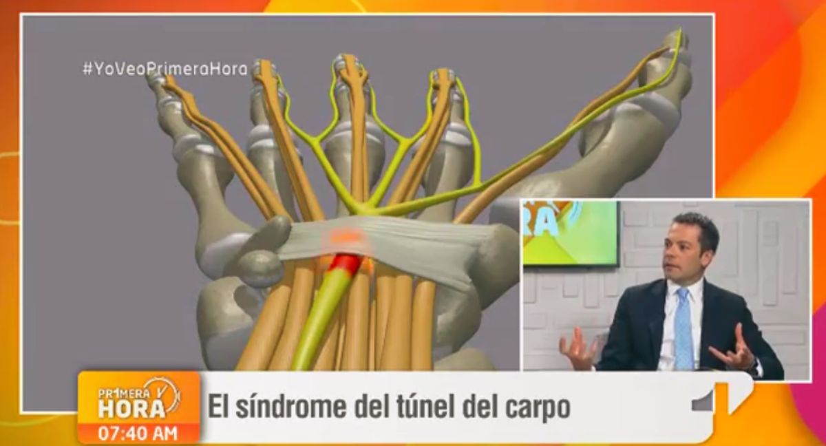 Explicación del síndrome del túnel del carpo en "Primera Hora" / FOTO: Screenshot emisión "Primera Hora".