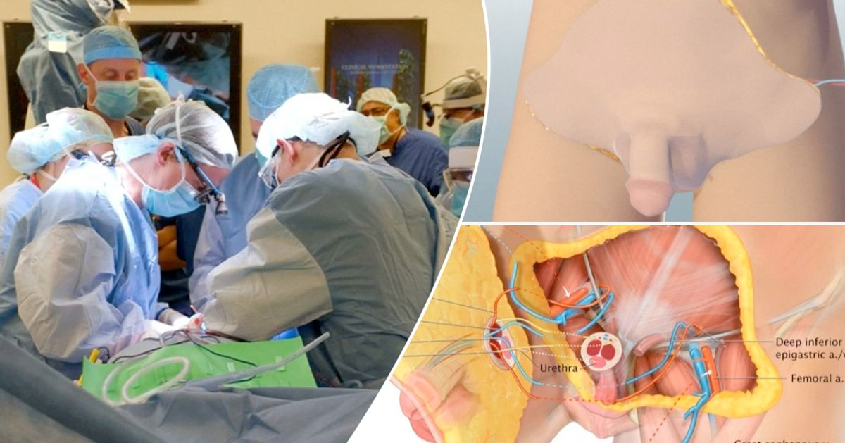 Soldado estadounidense recibe primer trasplante de pene y escroto del mundo