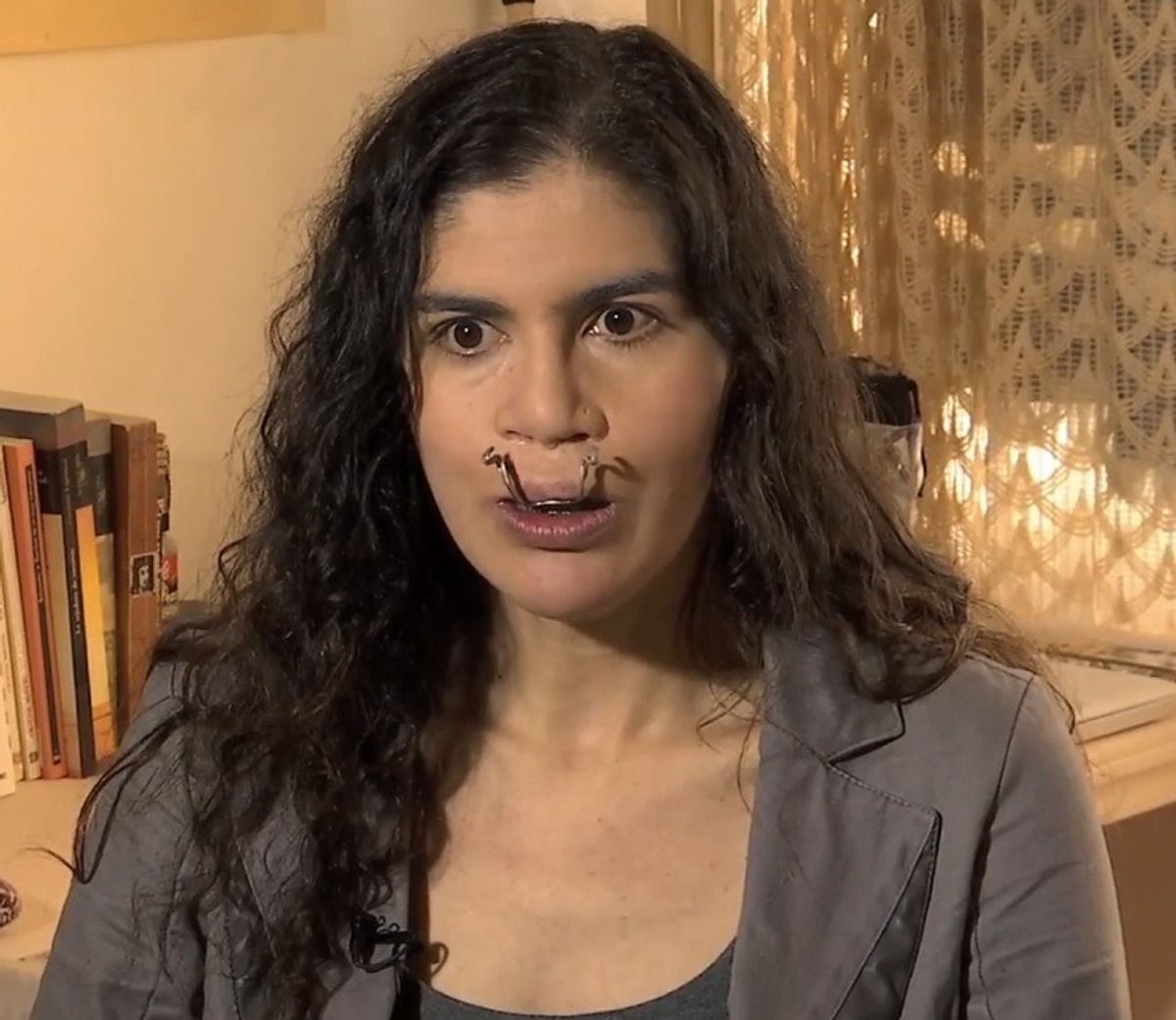 Académica desea acabar con su vida por discriminación por tener labio leporino