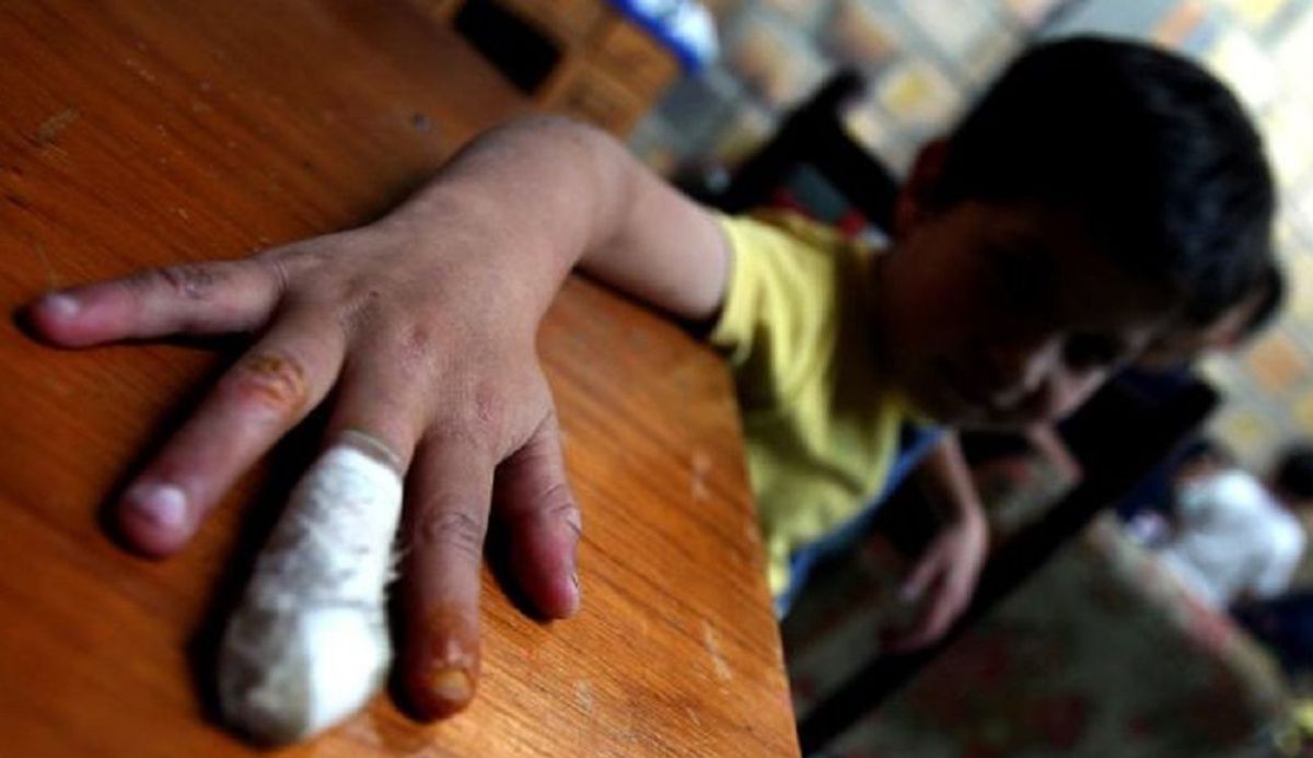Los niños, los más afectados por el uso de la pólvora en diciembre