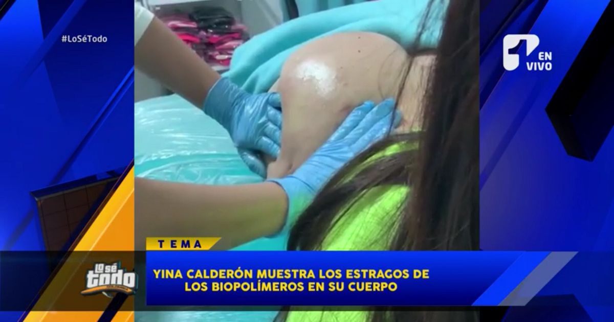 Yina Calderón mostró sin tapujos los estragos de los biopolímeros en su cuerpo