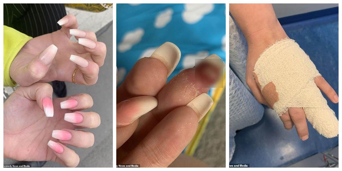 Esta mujer estuvo a punto de que le amputaran su dedo luego de un ‘manicure’ ¡Tengan cuidado!