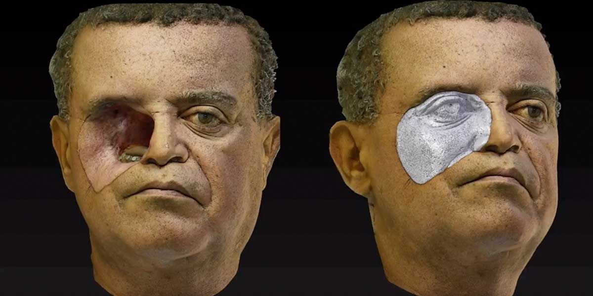 Fotos | Las prótesis faciales en 3D que podrían cambiarles la vida a los pacientes con cáncer