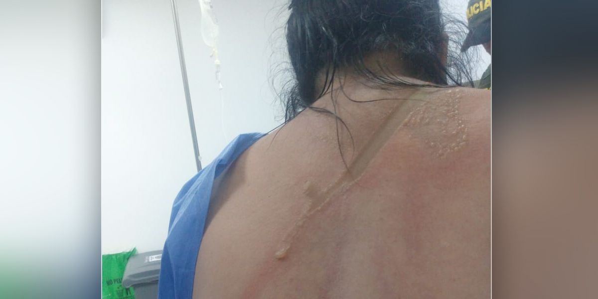 Mujer fue quemada con ácido por tercera vez en Neiva
