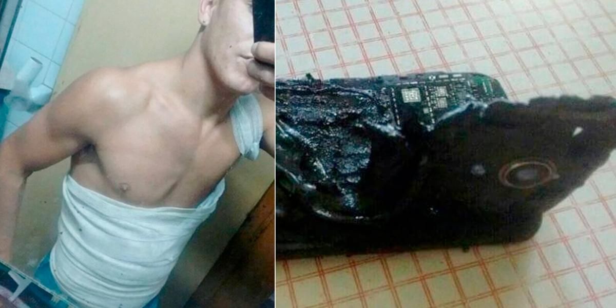 ¡Tenga cuidado! Joven argentino con quemaduras graves tras explotar teléfono mientras dormía