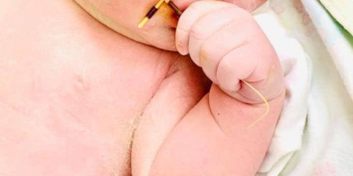 Bebé nació con dispositivo intrauterino de su mamá en la mano y la imagen se hizo viral