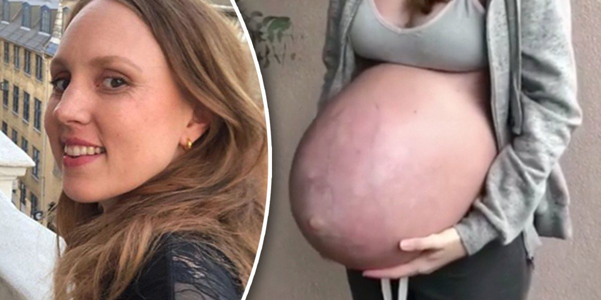 María Nordo Jorstad embarazo trillizos