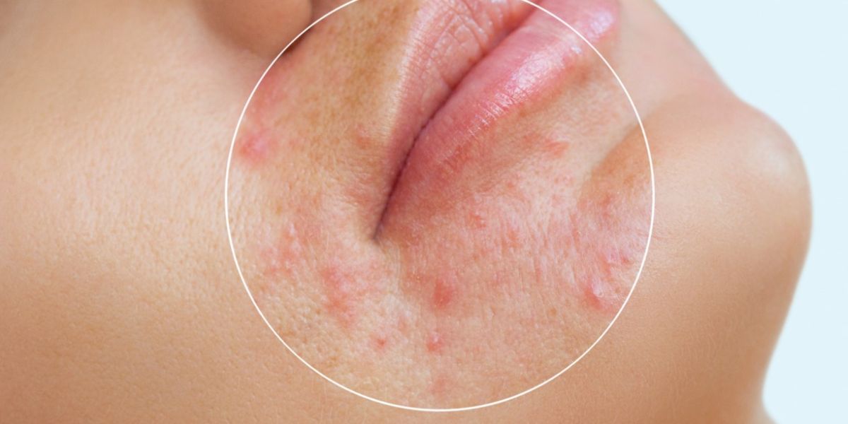 El uso prolongado del tapabocas puede causar acné, pero así lo evitas