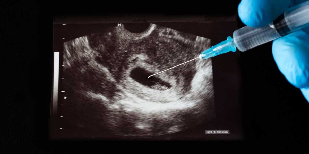 aborto interrupcion del embarazo