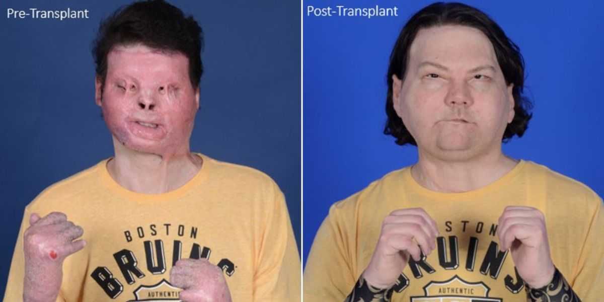 Joe DiMeo primer transplante cara y manos videos fotos