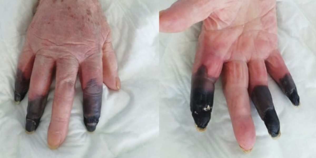 dedos covid extraño sintoma coronavirus vasculas italia