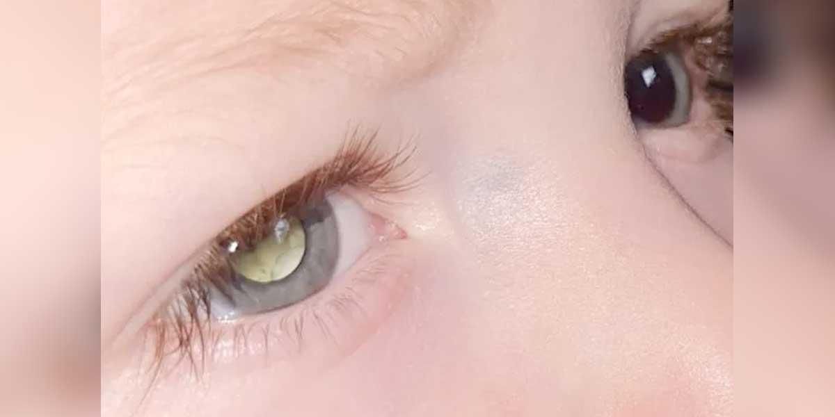 Mujer notó extraño brillo en los ojos de su hijo, pero el diagnóstico fue devastador
