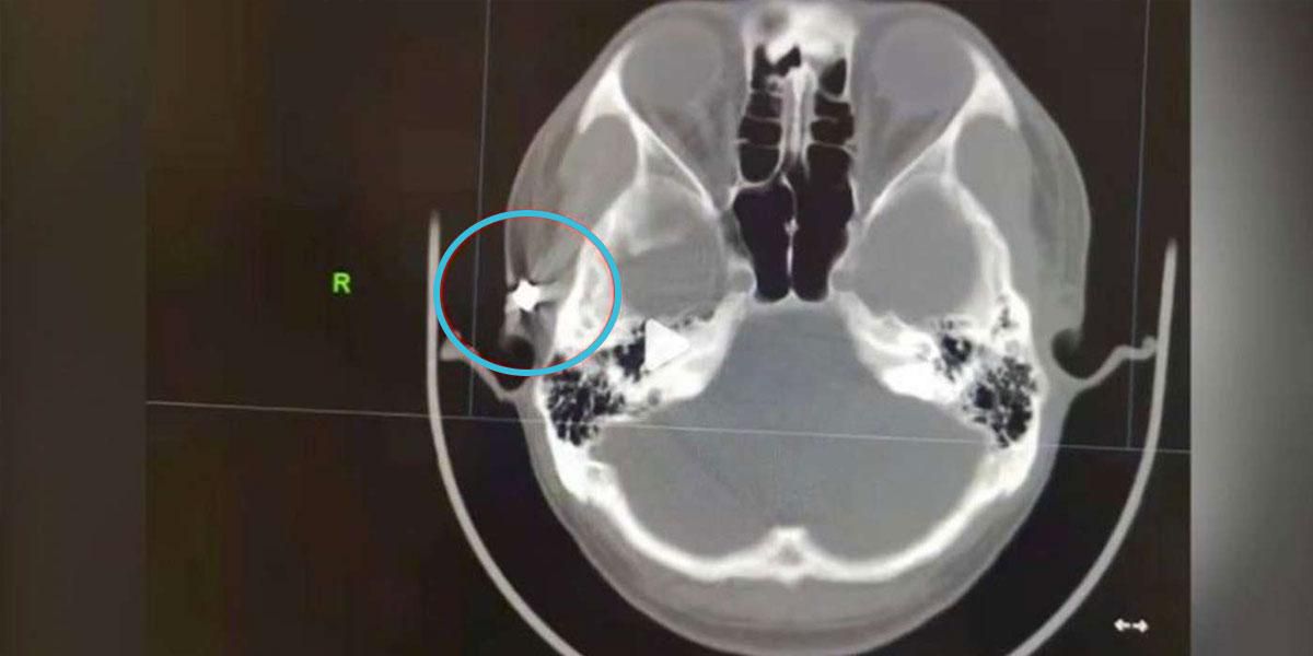 Descubren bala en cráneo de hombre que padeció 20 años dolores de cabeza