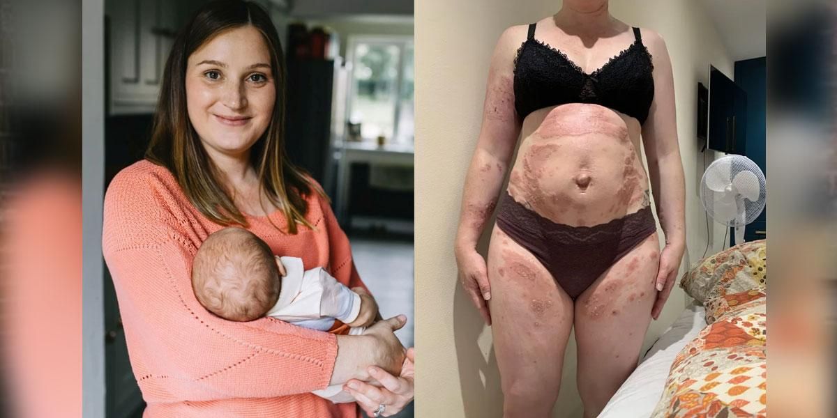 "Era como si fuera alérgica a mi propio bebé": le producía ampollas en todo su cuerpo