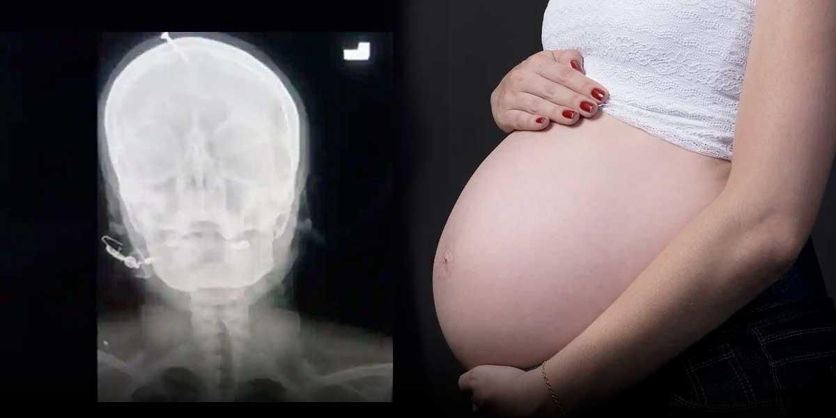 Enterró un clavo en el cráneo de su esposa embarazada para que el hijo ‘naciera varón’