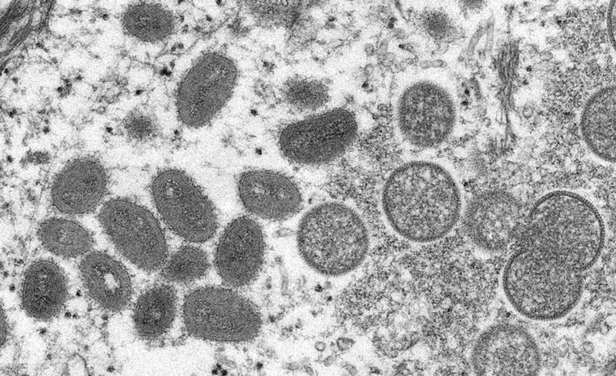 Alarma en Europa por nuevos casos de viruela del mono: Francia y Bélgica detectan primeros contagios