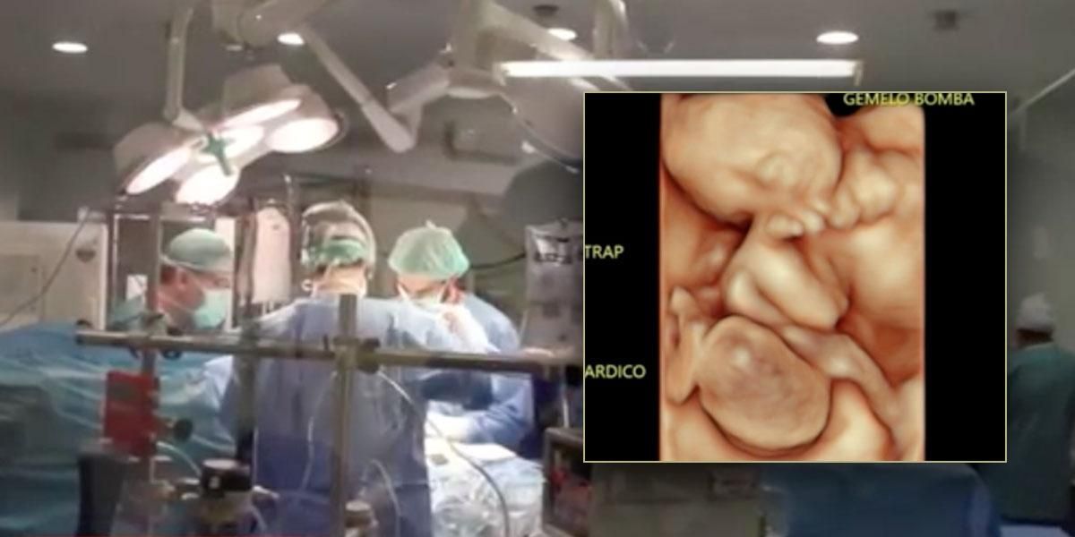 Increíble procedimiento: separan a gemelos en el vientre de su madre en Barranquilla