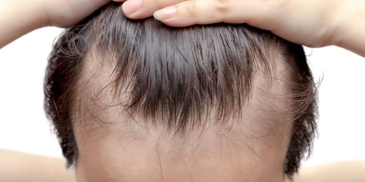 Qué es y cómo tratar la alopecia