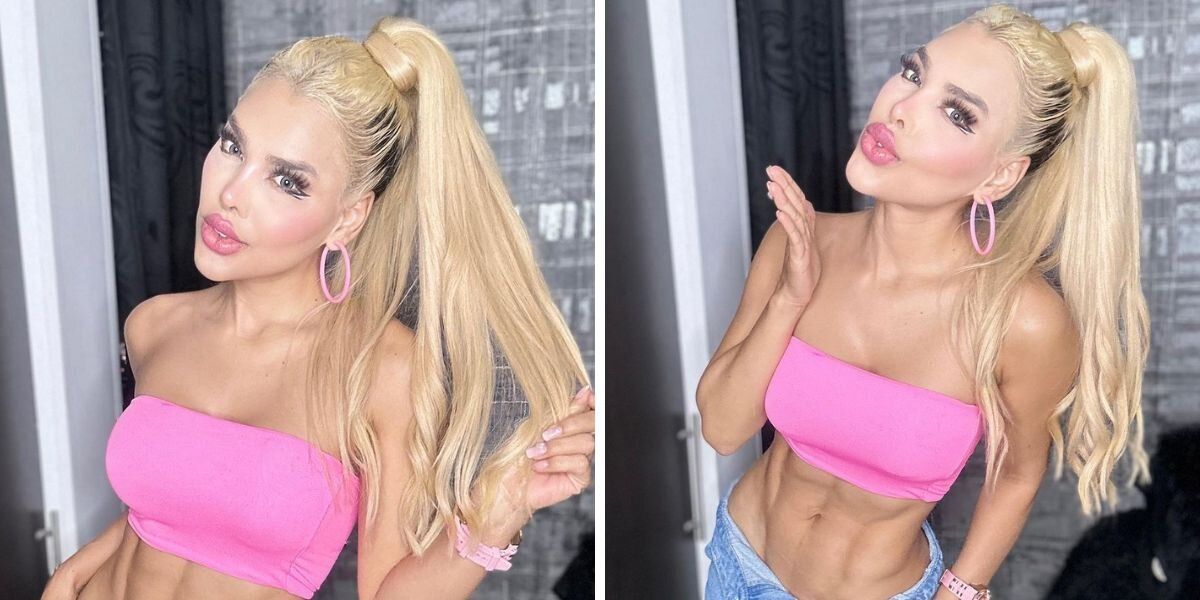 La 'Barbie Colombiana' mostró su extracción de pómulos