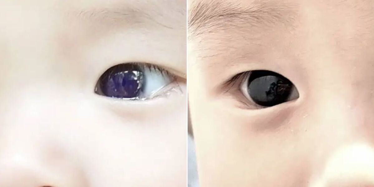 ¡Qué ojos! Un bebé de seis meses cambió el color de sus ojos luego de que le dieran un antiviral para el COVID-19.