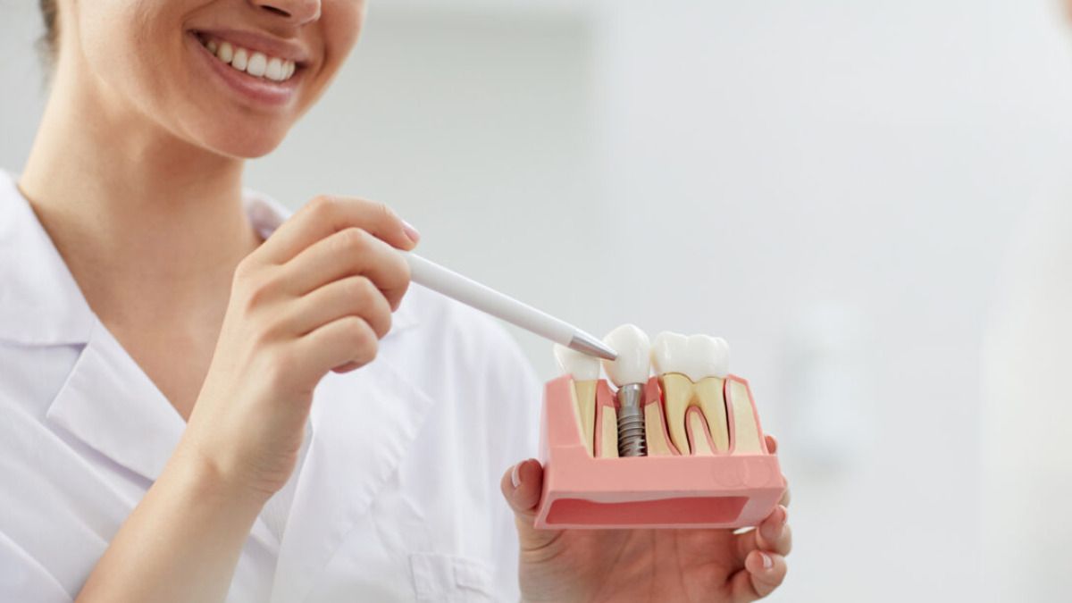 ¿Perdiste un diente? Conoce los beneficios e importancia de los implantes dentales